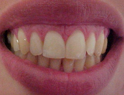 Diastemas - Dentes Separados